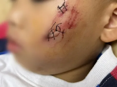 Đồng Nai: Bé trai 2 tuổi ở TP. Biên Hòa bị chó nghi dại cắn rách má