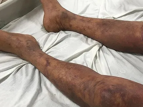 Người đàn ông tím đen cơ thể sau khi ăn thịt lợn ốm