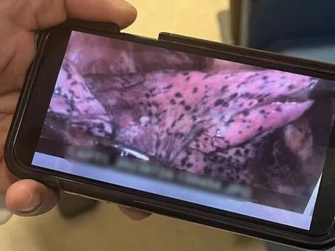 Chàng trai 20 tuổi có phổi chi chít đốm đen: “Phổi của tôi bị tổn thương vĩnh viễn chỉ vì một thói quen sai lầm”