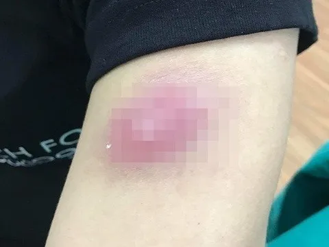 Hà Nội: Chi hàng chục triệu tiêm tan mỡ cô gái trẻ nổi u cục chi chít