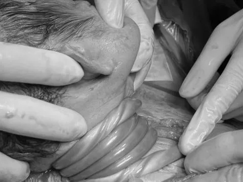 Cấp cứu kịp thời trường hợp suy thai cấp do dây rốn quấn cổ 5 vòng