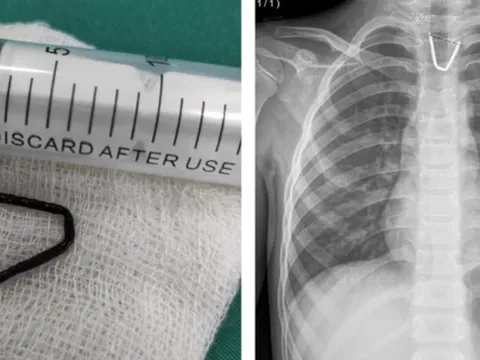 Hoảng hồn khi thấy đoạn kim khí sắc nhọn mắc trong họng bé 8 tuổi