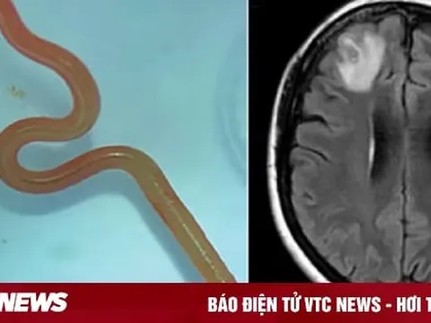 Gắp con giun còn sống ngoe nguẩy trong não người phụ nữ