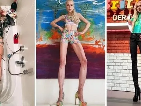 Nữ người mẫu bị chỉ trích vì chi gần 4 tỷ đồng để kéo dài chân