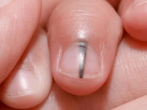 6 dấu hiệu cảnh báo trước khi ung thư ập đến, ít ai chú ý tới