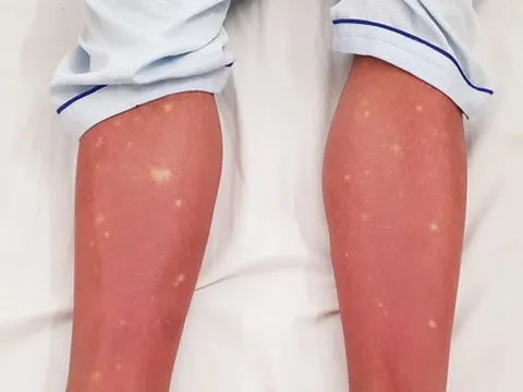 Nên xét nghiệm sốt xuất huyết ở ngày thứ mấy?