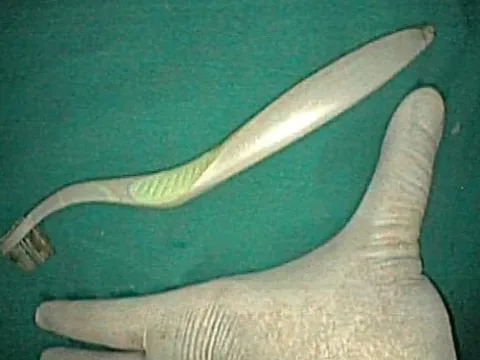 Hy hữu: Cô gái nuốt cả bàn chải đánh răng dài hơn 20cm vào bụng