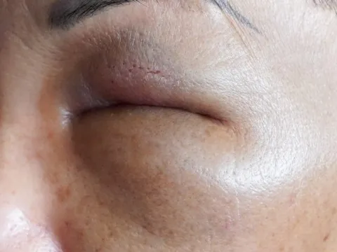 Nửa đêm cấp cứu vì vào nhà nghỉ tiêm filler làm đẹp giá rẻ