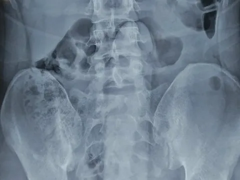 Nam thanh niên mắc kẹt đồ chơi tình dục trong... trực tràng