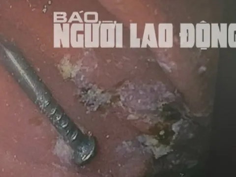 Bé trai gặp nguy hiểm khi nuốt cây đinh lúc đang chơi đùa