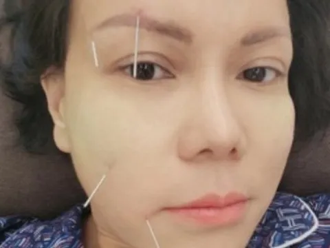 Vài sao Việt không may bị liệt nửa mặt, có người đứng trước nguy cơ đột quỵ