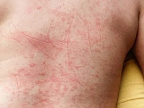 Số ca sốt xuất huyết ở Hà Nội tăng kỷ lục, có ca tử vong vì tự ý điều trị