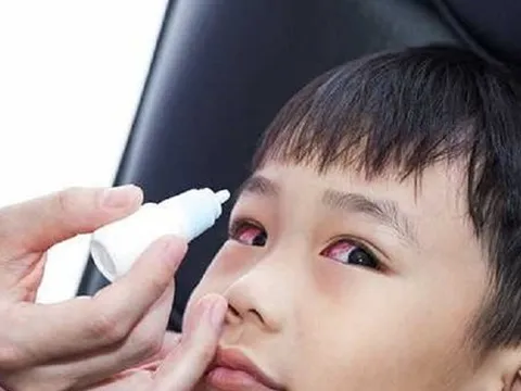 Sở Y tế TPHCM lên tiếng về thông tin bệnh đau mắt đỏ lây qua nước uống