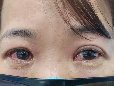 Người bệnh đau mắt đỏ cần làm gì và những lưu ý khi sử dụng thuốc nhỏ mắt