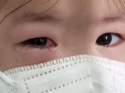 Bệnh đau mắt đỏ gia tăng, Bộ Y tế yêu cầu tăng cường giám sát