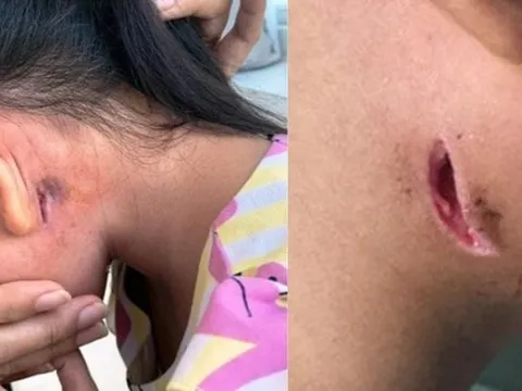 Nhiều người nhiễm vi khuẩn "ăn thịt người", Bộ Y tế ra khuyến cáo