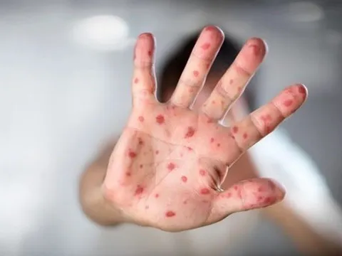 Đồng Nai ghi nhận ca bệnh đậu mùa khỉ đầu tiên