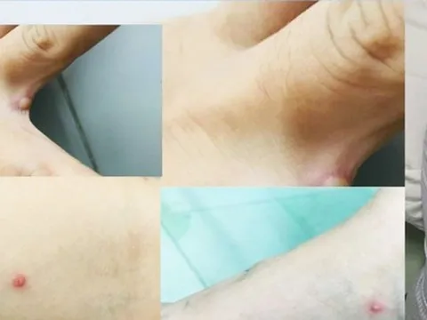 Đồng Nai phát hiện 1 ca đậu mùa khỉ, bạn gái cũng có triệu chứng mắc bệnh