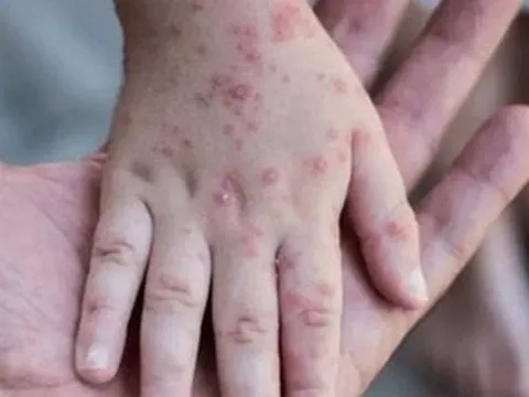 Đồng Nai: Xuất hiện ca mắc bệnh đậu mùa khỉ