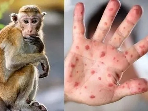 Ghi nhận 2 ca đậu mùa khỉ, Bộ Y tế đề nghị xác định nguồn lây