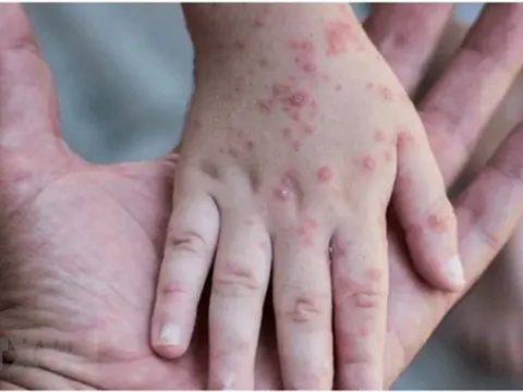 TPHCM ghi nhận thêm 4 ca mắc đậu mùa khỉ