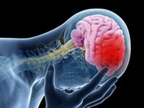 Đột quỵ sẽ tăng vọt, đặc biệt ở châu Á: Cảnh báo 4 lý do chính