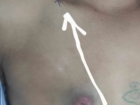 Sự thật bất ngờ sau vụ người đàn ông nói bị trúng "đạn lạc" vào ngực
