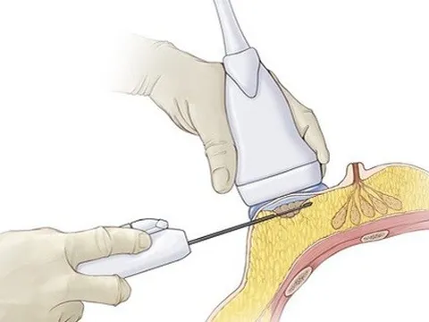 Hút u vú chân không có “thần kỳ” như quảng cáo?