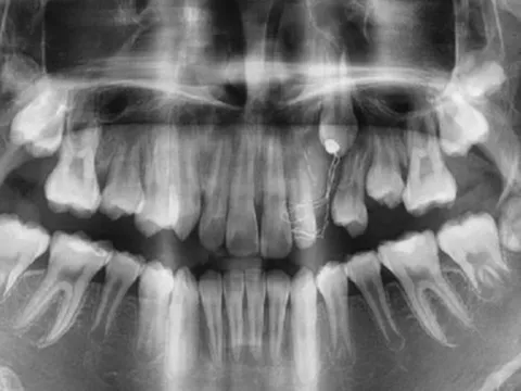 Thiếu niên 16 tuổi đột ngột sưng lợi, hoá ra u máu ác tính