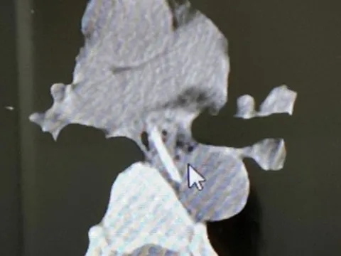 Hóc xương gà dài 3 cm, người đàn ông suýt mất mạng