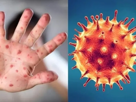 Người dân “gồng mình” phòng chống cùng lúc 5 loại dịch bệnh