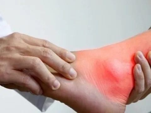 Bệnh gout có xu hướng trẻ hóa, bác sĩ chỉ cách phòng ngừa