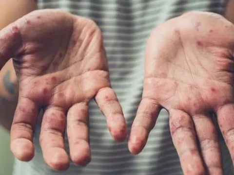 Chỉ trong 1 tuần TP HCM ghi nhận thêm 6 ca đậu mùa khỉ