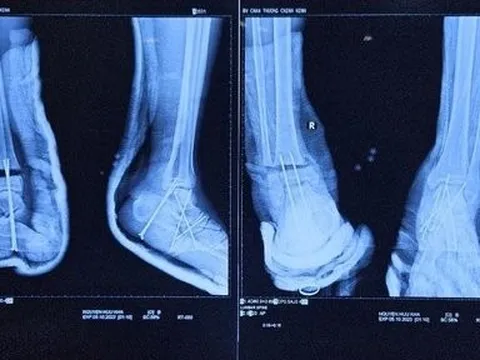 Hy hữu bệnh nhân bị đứt lìa cổ chân được phẫu thuật kịp thời