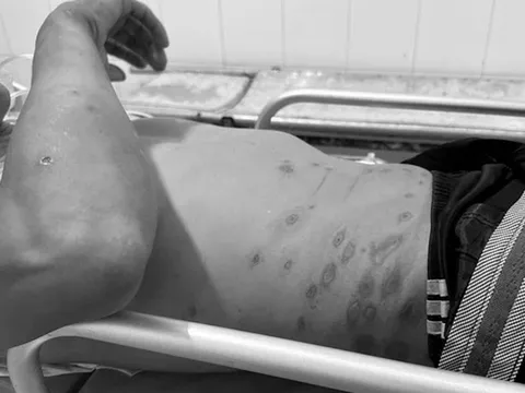 Sốc phản vệ nguy kịch do bị ong đốt