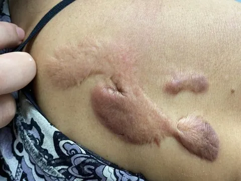 Người phụ nữ gánh tật vì "cú lừa" của spa