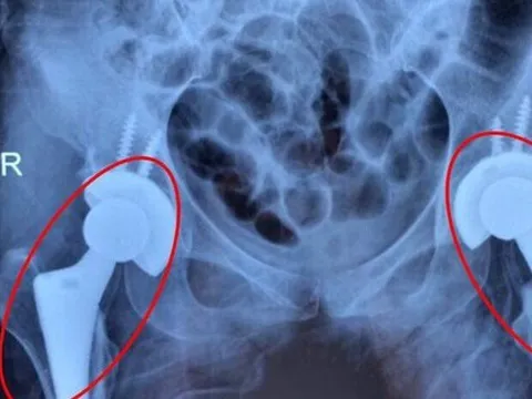 Nhiều người trẻ bị mục xương vì chất kích thích ai cũng dùng