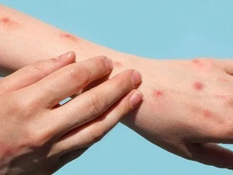 Trong 1 tuần TP HCM phát hiện thêm 15 ca đậu mùa khỉ