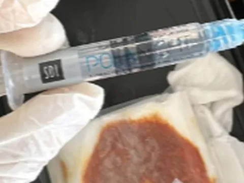 Tiêm filler trị thâm, nữ khách hàng bị tiêm ôxy già vào mắt