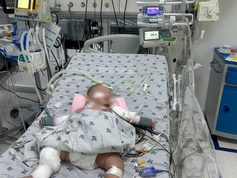 Bé 5 tháng tuổi nguy kịch do sốc sốt xuất huyết