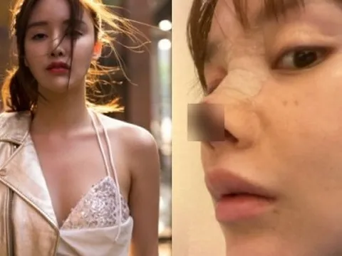 Nữ diễn viên biến chứng “dao kéo” kinh hoàng đến mức mất loạt vai diễn, cảnh báo chị em tránh xa 1 điều sau trải nghiệm đau đớn