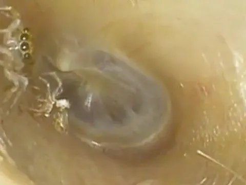 Thấy tiếng động lạ trong tai, người phụ nữ đi khám, phát hiện 'thủ phạm' kinh dị