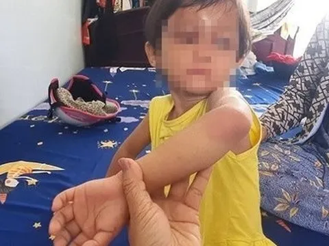 Hàng xóm giải cứu bé gái 4 tuổi nghi bị cha nuôi bạo hành