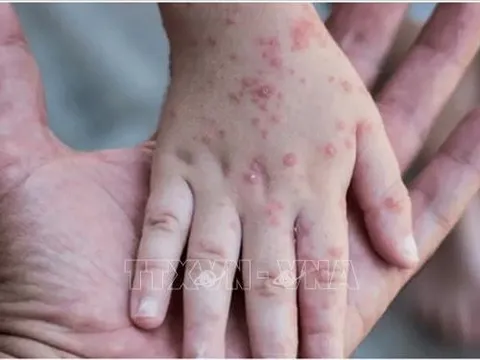 TP Hồ Chí Minh: 63 trường hợp mắc bệnh đậu mùa khỉ đều là nam giới