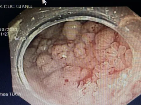 Vị trí đau tại bụng cảnh báo ung thư đại trực tràng