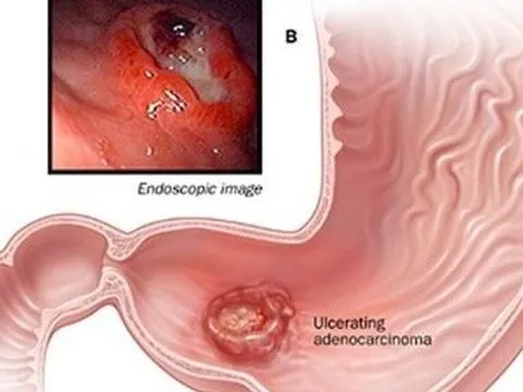Phó Giám đốc Bệnh viện K chỉ rõ dấu hiệu cảnh báo sớm ung thư dạ dày