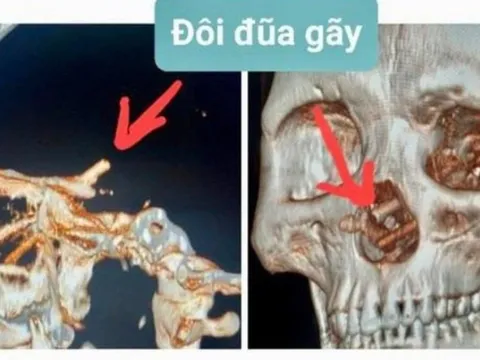 Bị bạn nhậu đâm đũa xuyên từ mũi lên não 5 tháng mà không hay biết
