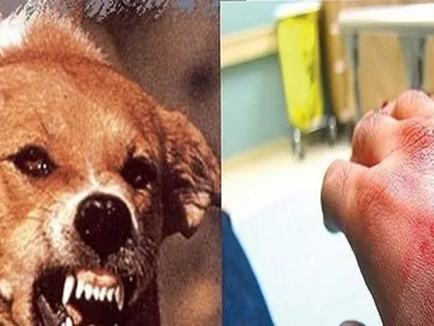 Chủ nhà tử vong sau 3 tháng bị chó cắn vào cổ tay