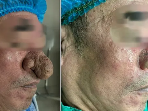 Người đàn ông bị mũi sư tử