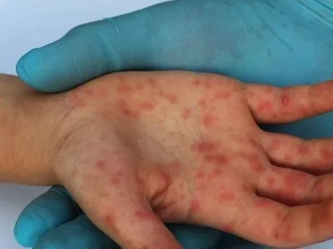 Tiền Giang ghi nhận ca mắc đậu mùa khỉ đầu tiên